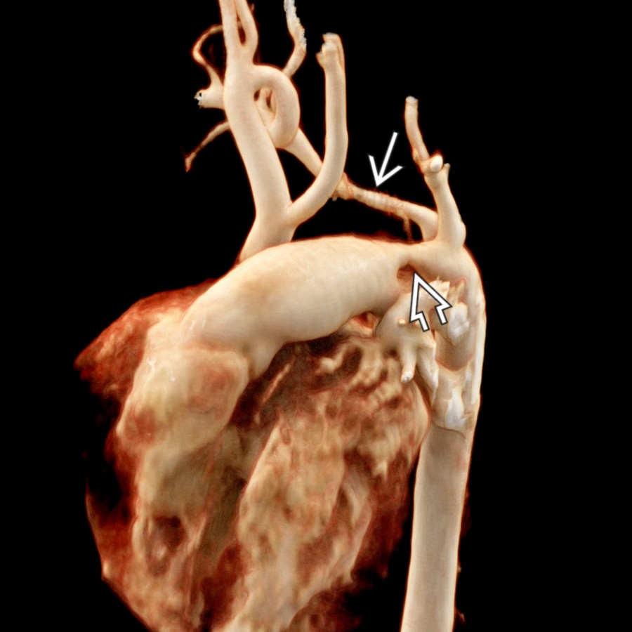 Anterosuperior oblique CTA cinematic rendering shows type B interrupted aortic arch (IAA) with aberrant right subclavian artery
. Patent ductus arteriosus (PDA)
provides blood flow to both subclavian arteries and the distal descending aorta (DA).