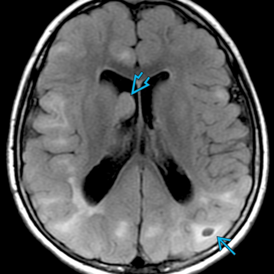 Axial FLAIR MR in a 6-year-old boy with tuberous sclerosis complex (TSC) shows a moderate to severe burden of cerebral tubers and right subependymal giant cell astrocytoma (SEGA)
. Cystic change is seen in a left parietal lobe tuber
. Tubers are dysplastic lesions that are present in nearly all patients with TSC.