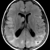Axial FLAIR MR in a 6-year-old boy with tuberous sclerosis complex (TSC) shows a moderate to severe burden of cerebral tubers and right subependymal giant cell astrocytoma (SEGA)
. Cystic change is seen in a left parietal lobe tuber
. Tubers are dysplastic lesions that are present in nearly all patients with TSC.