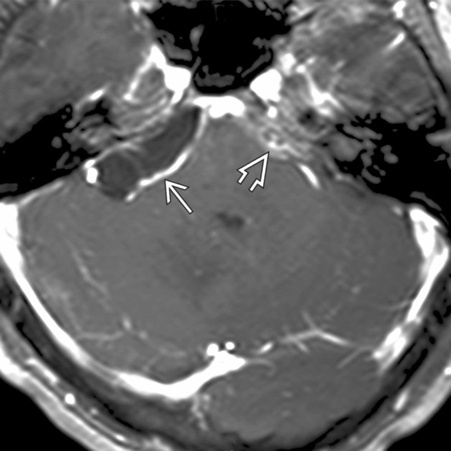 Axial T1 C+ FS MR demonstrates a cystic mass in the right CPA cistern with a peripherally enhancing wall
. Adjacent enhancing, thickened meninges
are also seen.