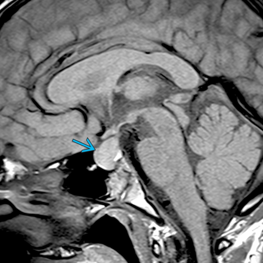 Sagittal T1 MR in a teenager with hypothyroidism shows marked enlargement of the pituitary gland
related to pituitary hyperplasia. The pituitary gland returned to normal size after the hypothyroidism was treated.