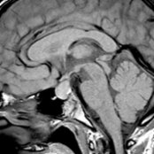 Sagittal T1 MR in a teenager with hypothyroidism shows marked enlargement of the pituitary gland
related to pituitary hyperplasia. The pituitary gland returned to normal size after the hypothyroidism was treated.