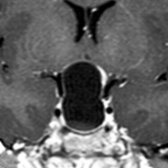 Coronal T1 C+ MR shows very large combined intra- and suprasellar cystic mass. Note the rim enhancement
with a nonenhancing layer of debris
within the cyst. Rathke cleft cyst was found at surgery.