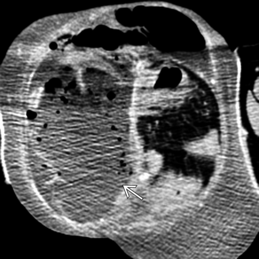 Axial CECT in an older man who presented with sepsis and a large right scrotal mass demonstrates a large scrotal abscess
from perforated incarcerated bowel within an inguinal hernia.