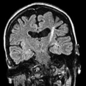 Coronal FLAIR MR shows linear hyperintensity
along the CST from the precentral gyrus to the cerebri crus. Right CST signal abnormality is out of this imaging slice. Hyperintensity of the precentral gyrus subcortical white matter on FLAIR is a potentially useful and specific sign of ALS that is not seen in healthy, asymptomatic patients.