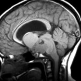 Sagittal T1WI MR shows a complex predominantly cystic suprasellar mass. Note the T1 shortening within the cyst due to machine oil-like proteinaceous fluid
.