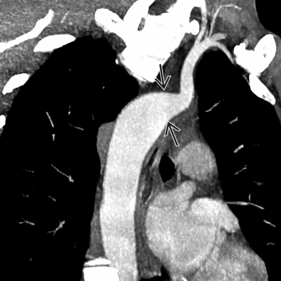 Oblique coronal chest CTA reformation in the same patient shows a bulbous configuration
of the origin of the ALSA, a classic feature of KD. KD is a consequence of the presence of a ductus arteriosus on the side of the SCA. Pathophysiologically, patients with KD may have symptoms (e.g., dysphagia lusoria) related to a vascular ring completed by the ligamentum arteriosum.