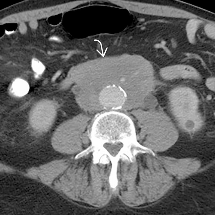 Axial CECT shows a rind of mass-like soft tissue
encasing the aorta and inferior vena cava. While more mass-like than is typical, this was found to represent retroperitoneal fibrosis.