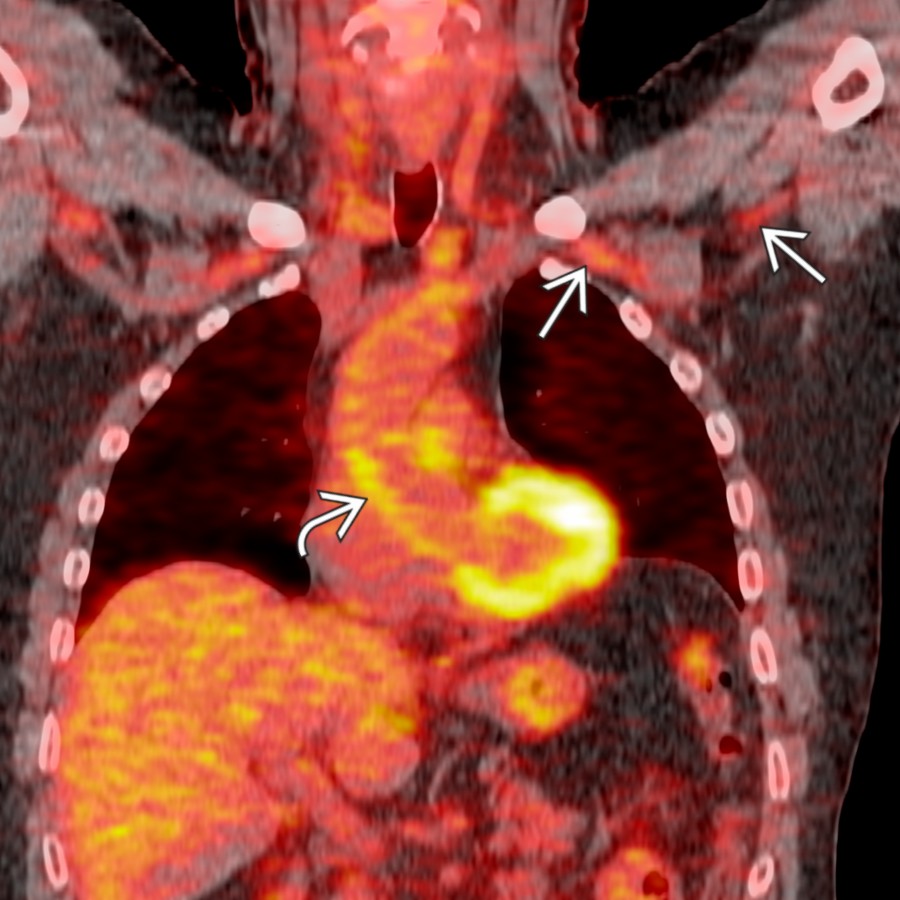 Coronal FDG PET/CT in a patient with GCA shows diffuse uptake along the ascending aortic wall
as well as along the subclavian and axillary arteries bilaterally
.