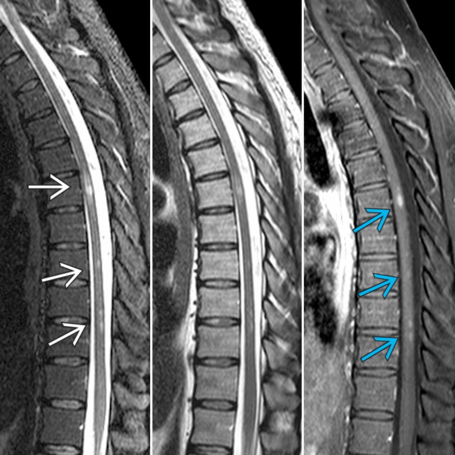 Sagittal T2 (left), T2 (middle), & T1 C+ FS (right) MR of the thoracic spine show multiple short-segment foci of T2 hyperintensity
in this patient with MS. Multiple lesions show solid enhancement
.