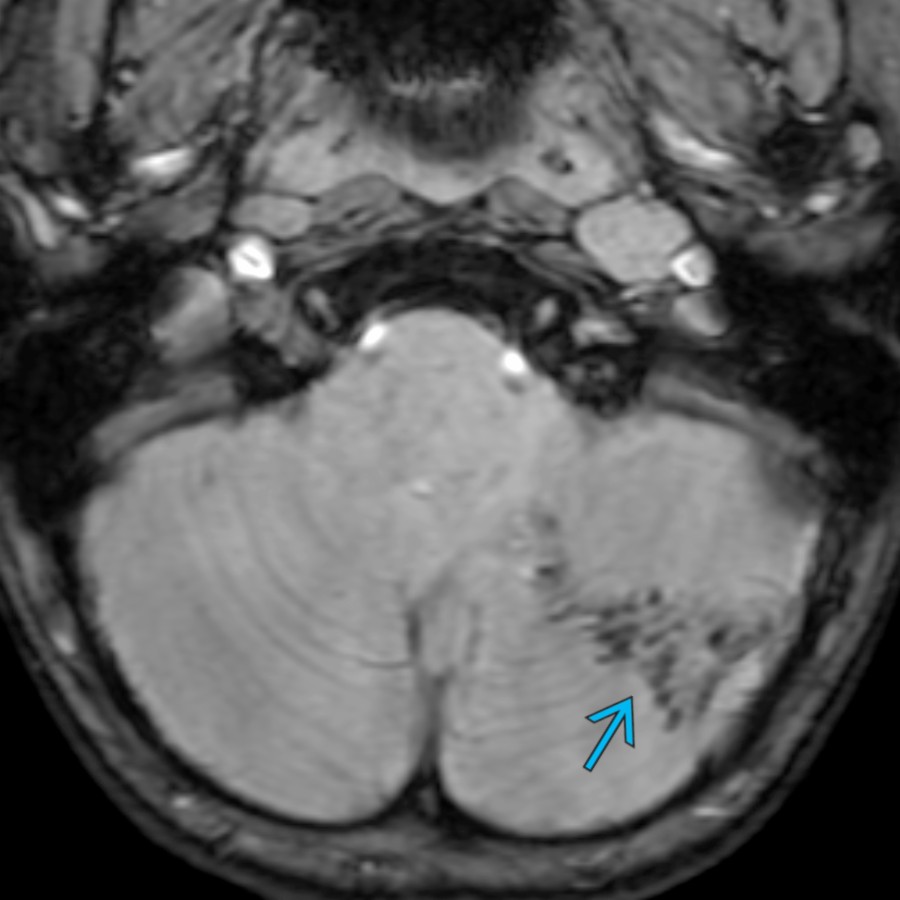 Axial SWI MR in a 4-year-old boy with TSC shows signal loss within a calcified, wedge-shaped cerebellar tuber
. Approximately 1/3 of all cerebellar tubers are calcified. In contrast to cerebral tubers, which show gyral expansion, cerebellar tubers typically show volume loss.