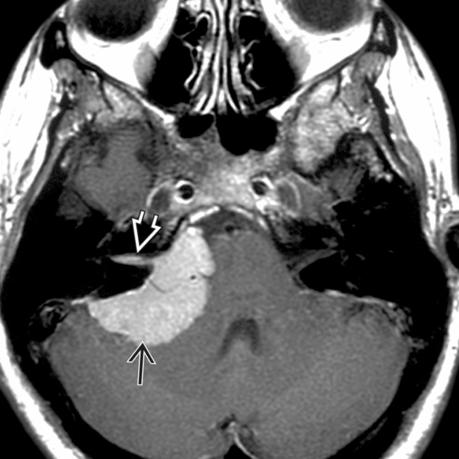 Axial T1 C+ MR shows a large, mushroom-shaped, enhancing mass
in the right cerebellopontine angle cistern. The mass has a broad base toward the dural surface. Note the dural tail sign
of reactive meningeal thickening in the internal auditory canal.