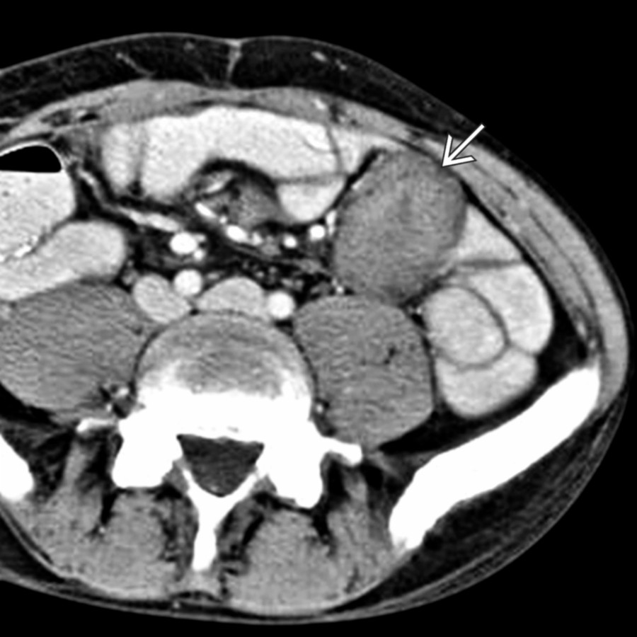 Axial CECT in a 36-year-old man 12 months following a colectomy for Gardner syndrome shows a solid mesenteric desmoid
.