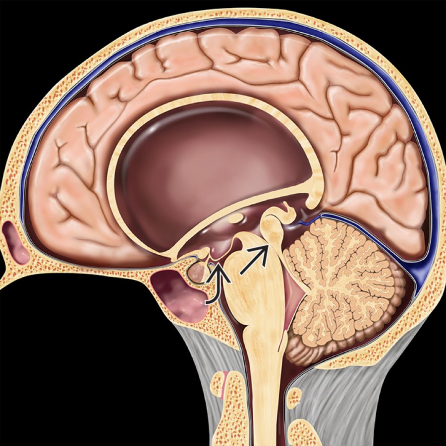Sagittal graphic shows obstructive hydrocephalus with markedly enlarged lateral and 3rd ventricles, a stretched (thinned) corpus callosum, and a funnel-shaped cerebral aqueduct
related to distal obstruction. Note the normal size of the 4th ventricle and depression of the floor of the 3rd ventricle
from the hydrocephalus.