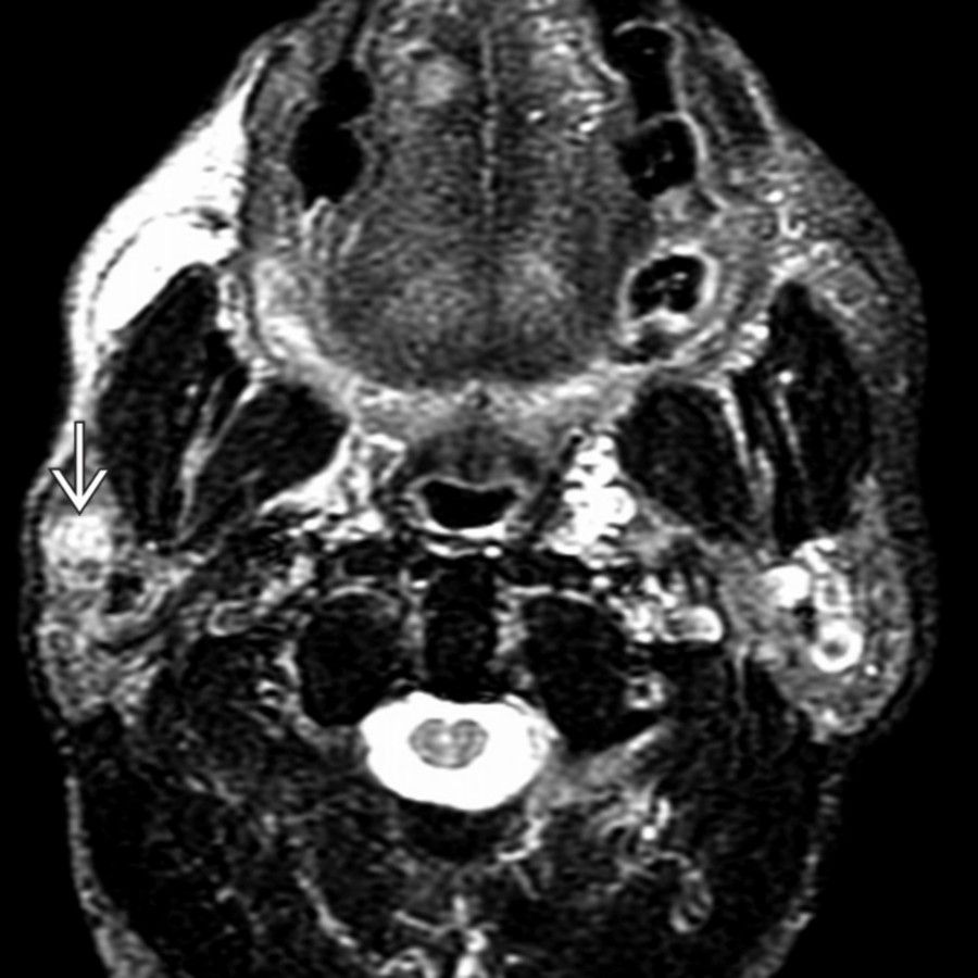 Axial T1 FS MR shows a small mass
in the superficial lobe of the parotid gland. It has heterogeneous high signal. There are no imaging features that would suggest schwannoma over the far more common benign mixed tumor (BMT).