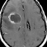 Axial T1 C+ MR shows an irregularly ring-enhancing cystic lesion with extensive surrounding vasogenic edema. The rim of the lesion is thinner medially than laterally, as is often seen with large pyogenic abscesses. Central DWI restriction was present (not shown).