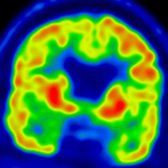 Coronal FDG PET in a 45 year old with slowly progressive dementia shows decreased metabolic activity in bilateral medial temporal lobes
, slightly greater on the right.