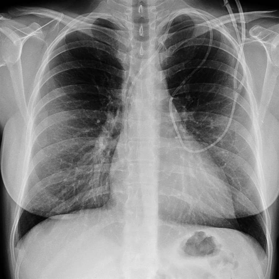 Frontal radiograph shows a normal cardiac silhouette in a patient with ischemic cardiomyopathy and a 40% ejection fraction. Compare with the next image, which was acquired 1 month later.