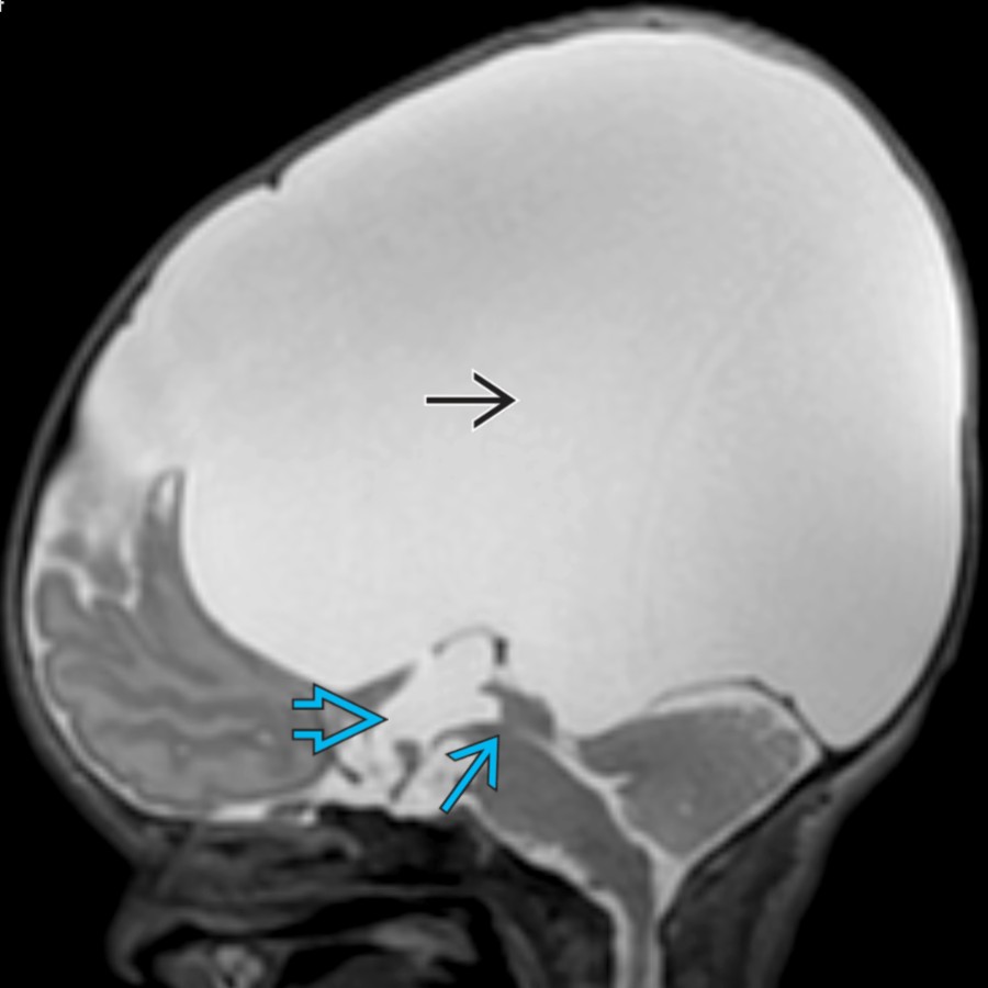 Sagittal T2 MR in a neonate shows massive enlargement of the lateral ventricles
due to obstruction at the level of the cerebral aqueduct
. The 3rd ventricle is also enlarged
, but the 4th ventricle is normal, typical of this disorder.