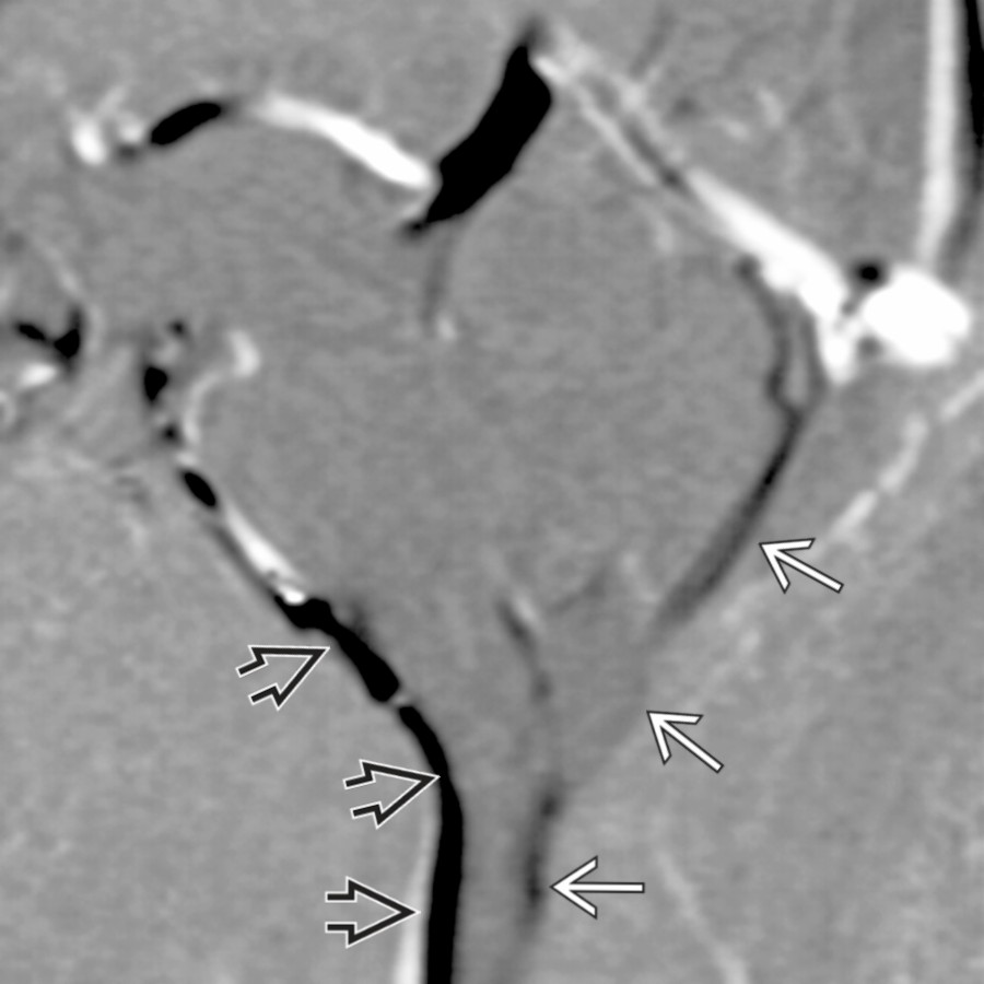 Sagittal CINE phase-contrast CSF flow - diastolic shows diminished posterior CSF flow
compared to anterior CSF flow
at the site of tonsillar impaction.