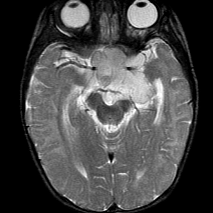 Axial T2 MR shows a predominantly T2-hyperintense mass in the suprasellar cistern with a shape similar to the optic chiasm. Pilocytic astrocytomas are the 2nd most common suprasellar mass in children.