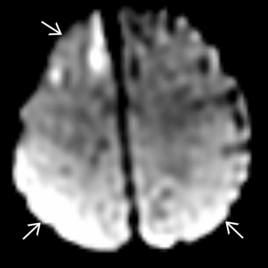 Axial DWI MR in a 2-month-old boy with AHT shows areas of diffusion restriction
in the right frontal lobe & bilateral parietal lobes, consistent with parenchymal injury. MR is the most sensitive examination for parenchymal injury.