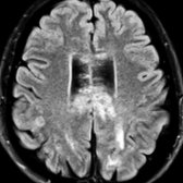 Axial FLAIR MR in a 28-year-old man with rapidly declining mental status after a flu-like illness shows patchy hyperintensities in the corpus callosum
and deep/subcortical WM
.