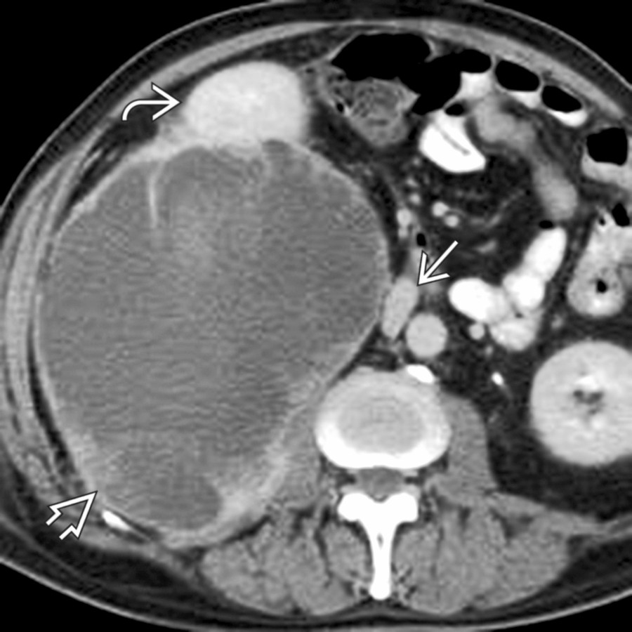 Axial CECT shows a large, heterogeneous retroperitoneal mass
, which displaces the right kidney
anteriorly. Note medial displacement of the inferior vena cava (IVC)
. Malignant fibrous histiocytoma.
