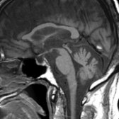Sagittal T1 MR in a 56-year-old man with fragile X-associated tremor/ataxia syndrome (FXTAS) demonstrates atrophy of the corpus callosum
, brainstem
, and cerebellum
.