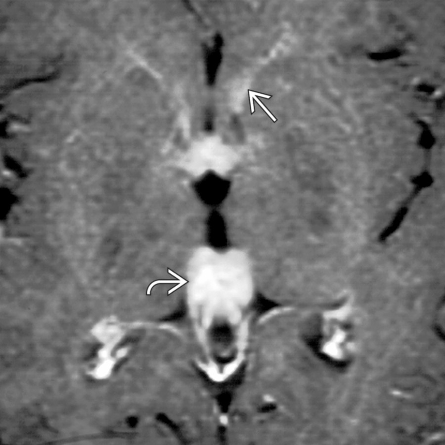 Axial T1 C+ MR shows enhancing masses of the pineal
and suprasellar regions in this patient with CSF spread of germinoma. An enhancing tumor infiltrates the ependyma of the frontal horns
.