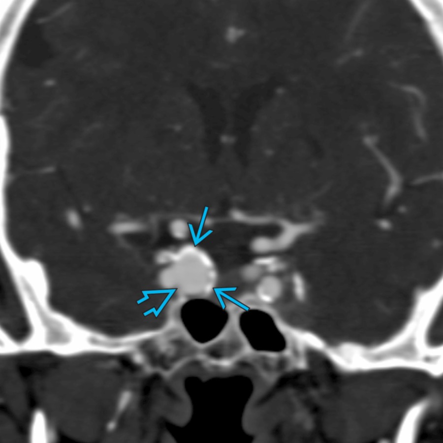 Coronal arterial-phase CTA shows a saccular aneurysm projecting medially from the right cavernous ICA with internal arterial enhancement
and rim calcifications
.