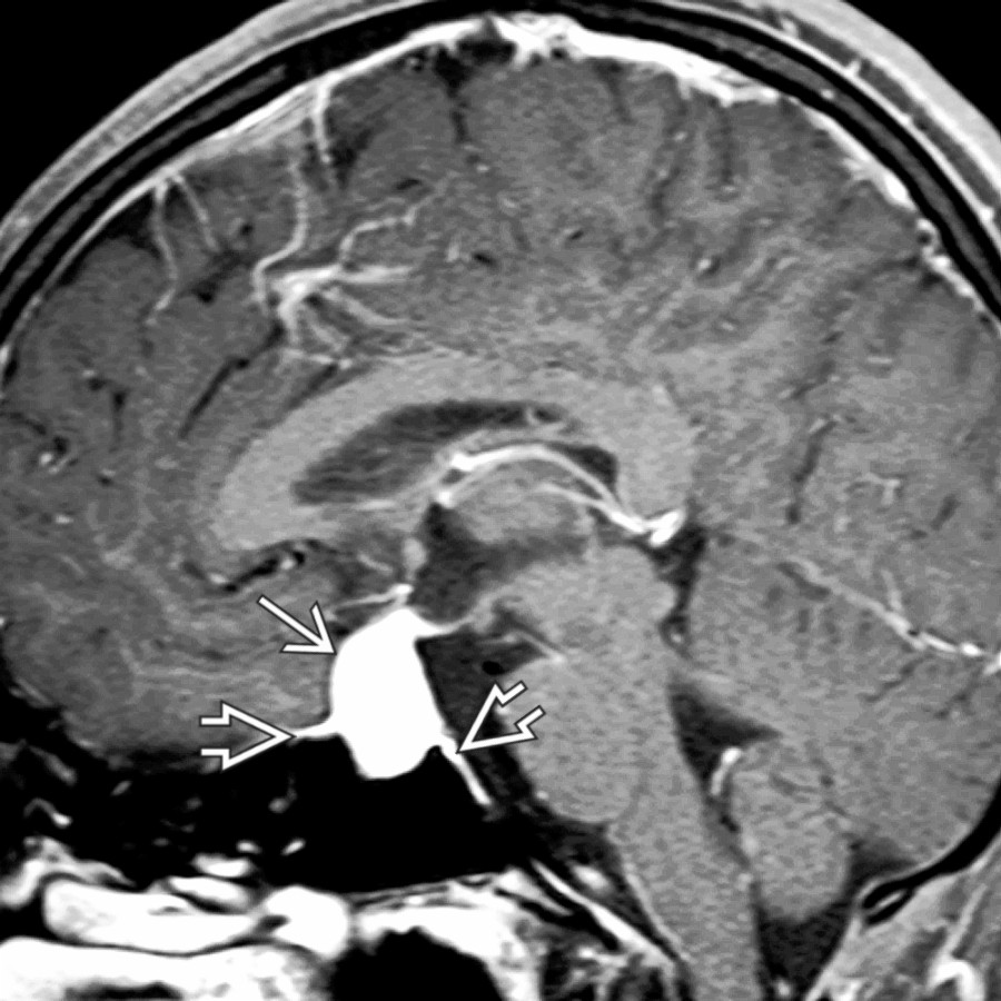 Sagittal T1 C+ FS MR in a pregnant teenager who developed acute onset of vision problems late in the 3rd trimester shows a large, enhancing mass
with reactive dural thickening
. The preoperative diagnosis was macroadenoma.