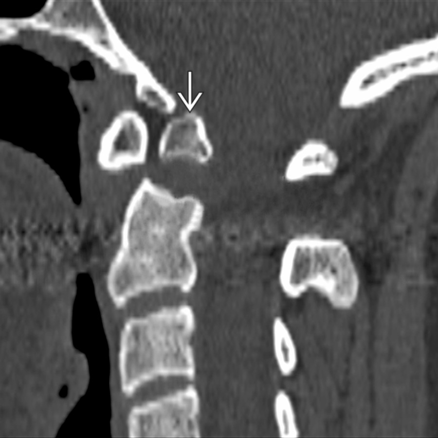 Sagittal bone CT shows a chronic, nonunited dens fracture
, so-called os odontoideum. This may be unstable, and flexion-extension views should be performed.