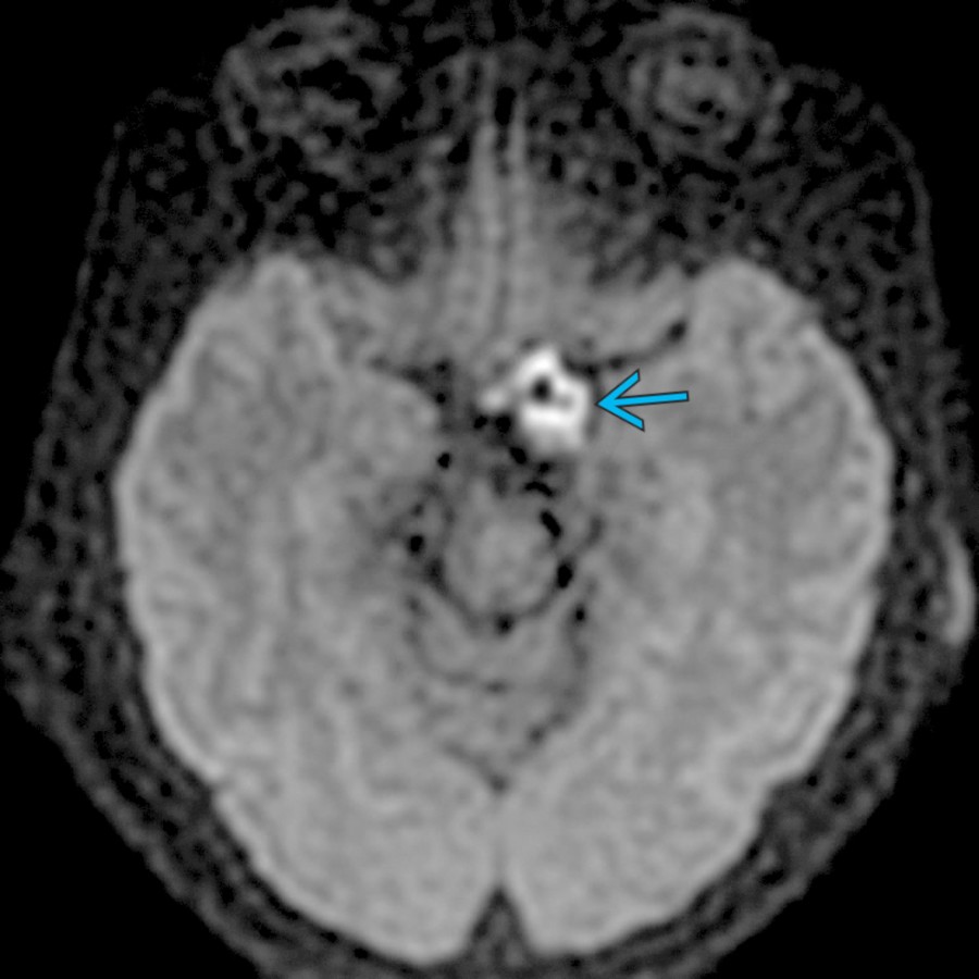 Axial DWI MR shows an epidermoid cyst in the left suprasellar cistern
. These benign cysts classically show restricted diffusion as seen in this example. They are often T2 hyperintense and lack suppression on FLAIR sequences. Surgical resection is the treatment of choice.