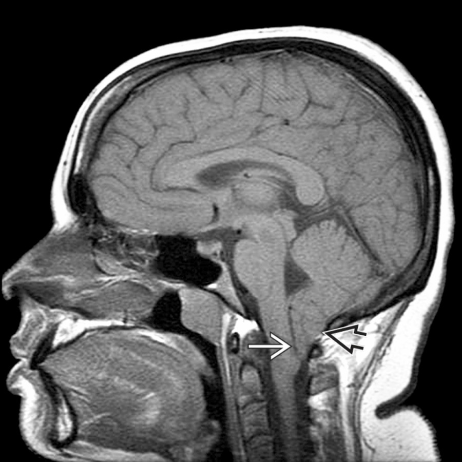Sagittal T1WI MR shows inferior extension of the peg-like cerebellar tonsils
well below the level of the foramen magnum
, consistent with Chiari 1.