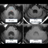 Axial routine T1WI MR shows BT-ratio measurement at the axial slice with largest visualization of MCP. The medial lemniscus is identified as lines of low intensity
. The distance of pontine base (B) is measured from ventral edge of pons to ventral edge of medial lemniscus (blue line). The distance of pontine tegmentum (T) is measured from ventral edge of medial lemniscus to dorsal edge of pons (red line). BT-ratio is B/T.