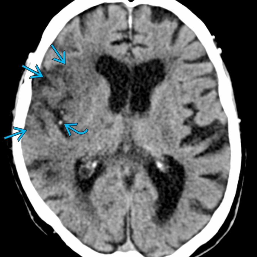 Axial NECT shows loss of gray-white differentiation of the frontal and temporal operculum as well as the insular cortex consistent with infarct
. Note the hyperdensity in the sylvian fissure from thrombosed middle cerebral artery (MCA) branches
.