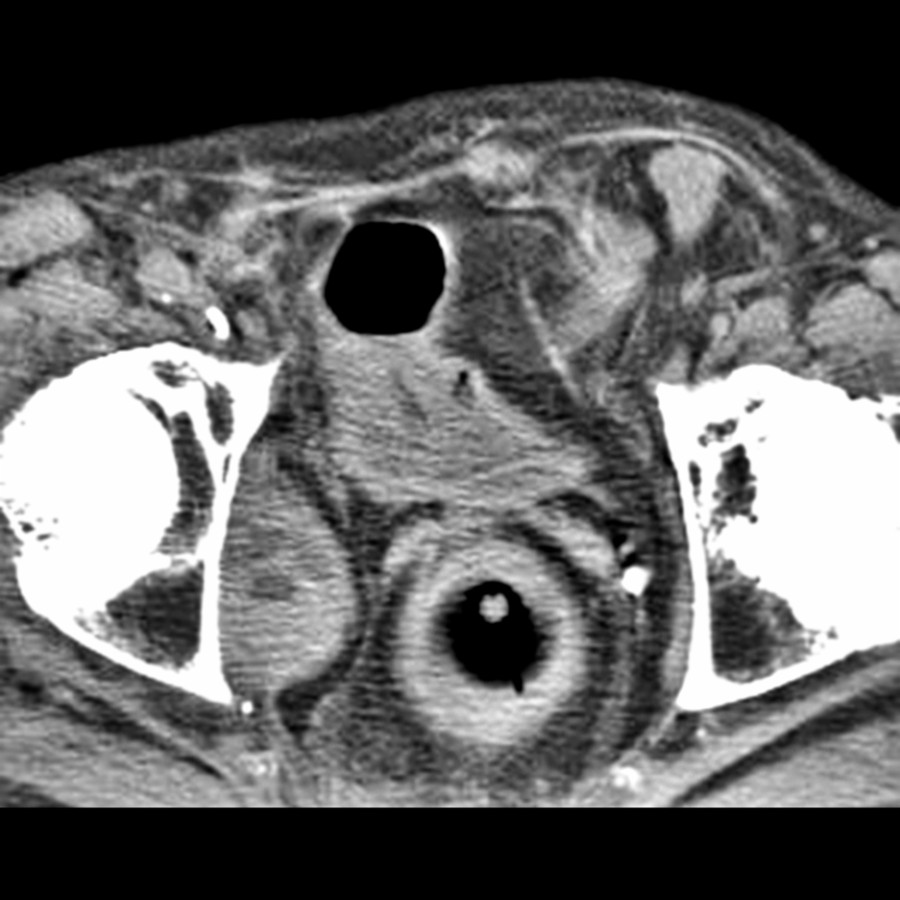 Axial CECT shows a left inguinal hernia at the upper end of the inguinal canal. There is a mass effect due to the herniated fat and bowel.