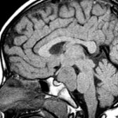 Sagittal T1WI MR in a child with precocious puberty shows a large, lobulated suprasellar mass
that is isointense with cortex and clearly separate from the pituitary gland and optic chiasm. The mass is so large it displaces the brainstem posteriorly.