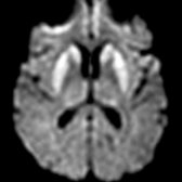 Axial DWI MR shows bilateral restricted diffusion in the putamen and caudate nuclei with small foci in thalami.