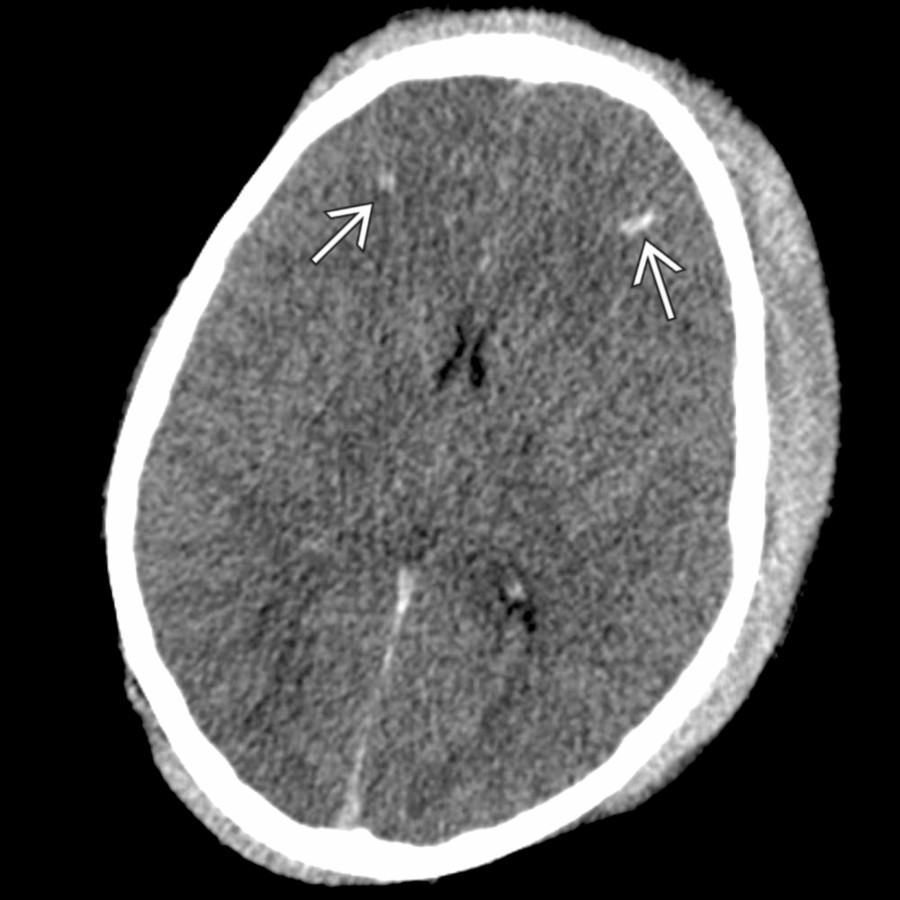 Axial CT in a 9-year-old injured by a horse shows bilateral scalp hematomas, effacement of sulci, loss of gray-white matter differentiation, and small lateral ventricles. Also note small foci of hemorrhagic shear-type injury
at the gray-white junction in the frontal lobes.