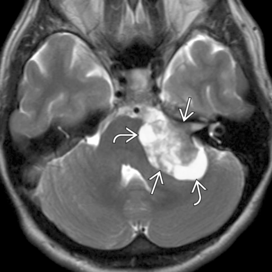 Axial T2 MR shows a heterogeneous CPA mass
extending into the left internal auditory canal. Note numerous large intramural tumor cysts
.