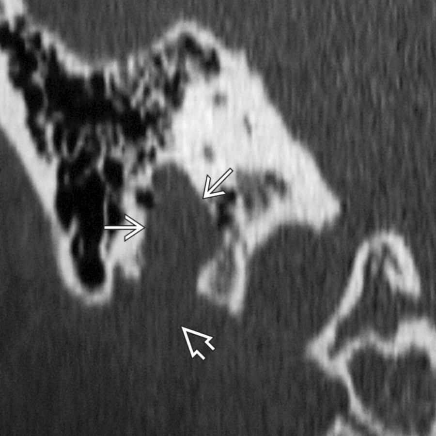 Coronal bone CT shows smooth expansion of the vertical segment of the facial canal
. The facial nerve schwannoma extends from the parotid gland
up through the stylomastoid foramen.