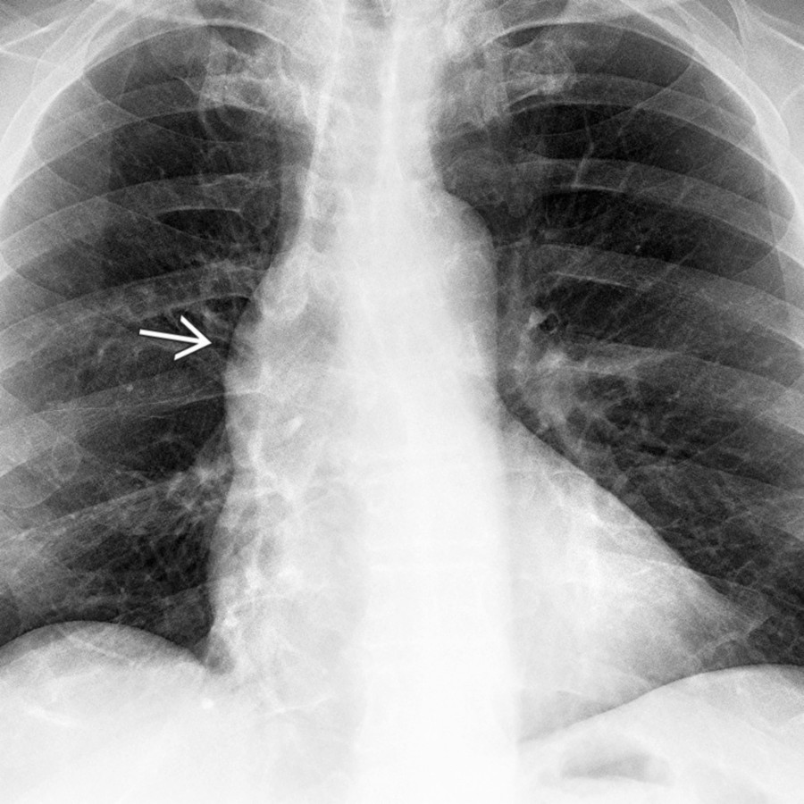 PA radiograph of the chest in a patient with MFS shows an abnormal convexity
along the right superior cardiac silhouette. This finding is often associated with a dilated ascending aorta. In young patients, it is commonly associated with bicuspid aortic valve and MFS.