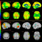 Clinical examination of a 72-year-old woman with AD shows typical findings for long history of memory deficit. FDG PET raw data and 3D SSP show preservation of the primary sensorimotor cortex
. There is hypometabolism involving the bilateral parietotemporal association cortices
and mild hypometabolism within the right greater than left posterior cingulate regions
and, to a lesser extent, the precuneus regions
. There is no hypometabolism in the primary visual cortices or frontal lobes. (Courtesy M. Matesan MD.)