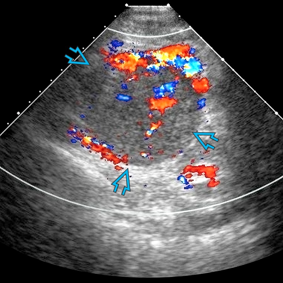 Transverse transabdominal color Doppler ultrasound shows heterogenous, hypervascular mass
anteromedial to the left kidney, confirmed paraganglioma.