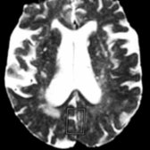 Axial T2WI MR through the lateral ventricles depicts atrophy of the superior aspect of the temporal lobes and parietal lobe atrophy. (Courtesy J. Norfray, MD.)