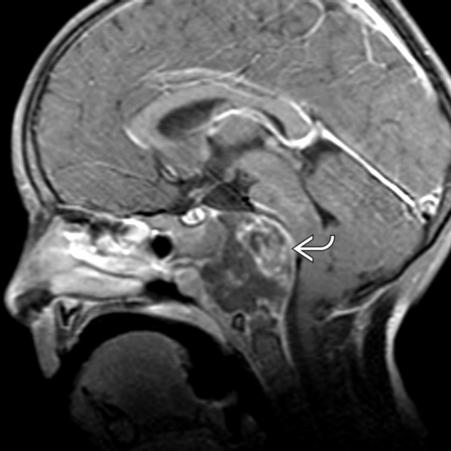 Sagittal T1 C+ MR demonstrates an isointense, expansile mass arising from the clivus
. Notice the posterior indentation, or "thumbing," of the pons.