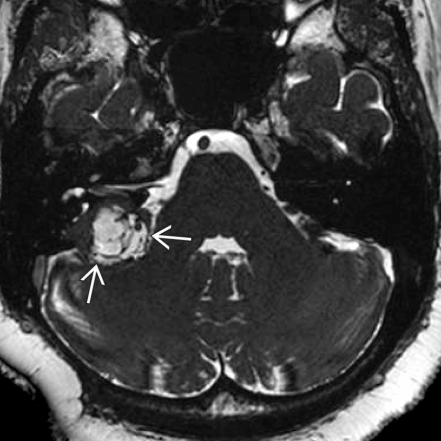 Axial high-resolution T2 MR shows a heterogeneous cystic CPA mass
. The key to diagnosis is identifying the mass origin from the posterior temporal bone in the expected location of the endolymphatic sac.