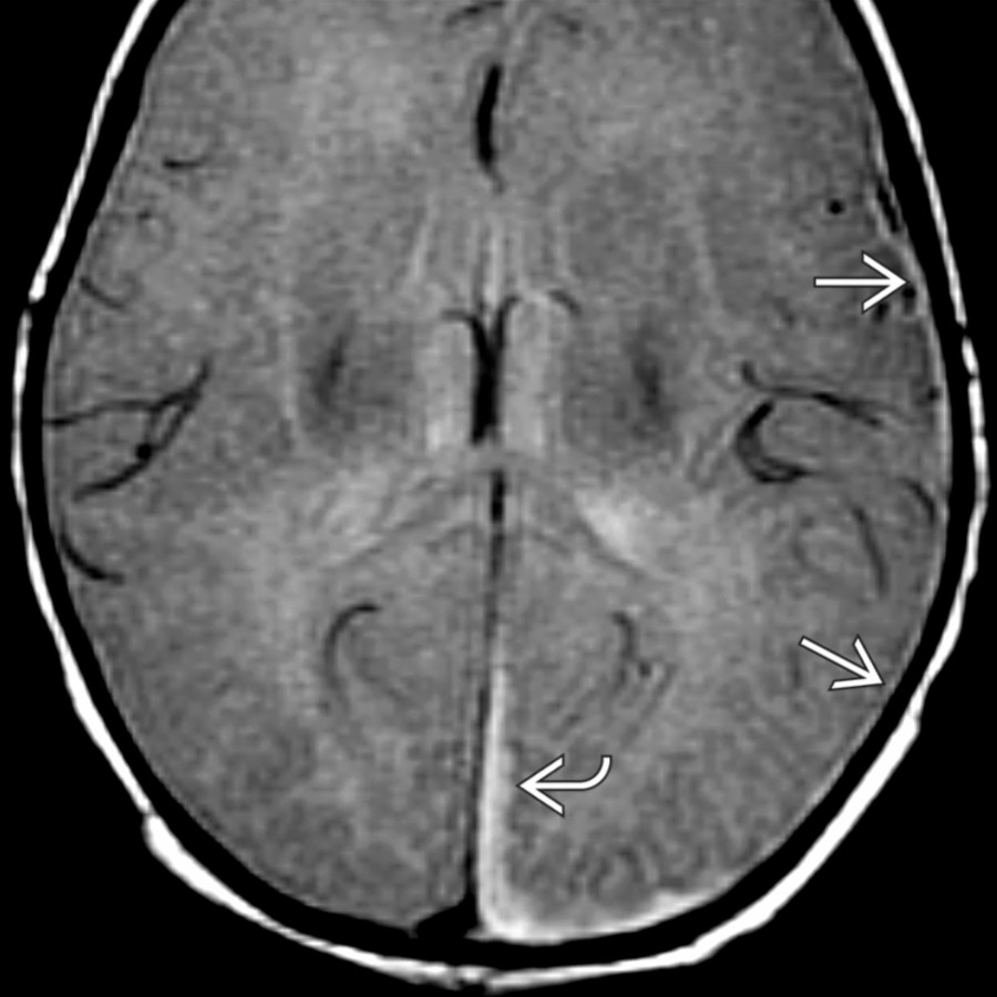 Axial PD MR shows a SDH over the left cerebral hemisphere. Although blood along the falx
would be seen, the small volume laterally
could be difficult to detect on CT.